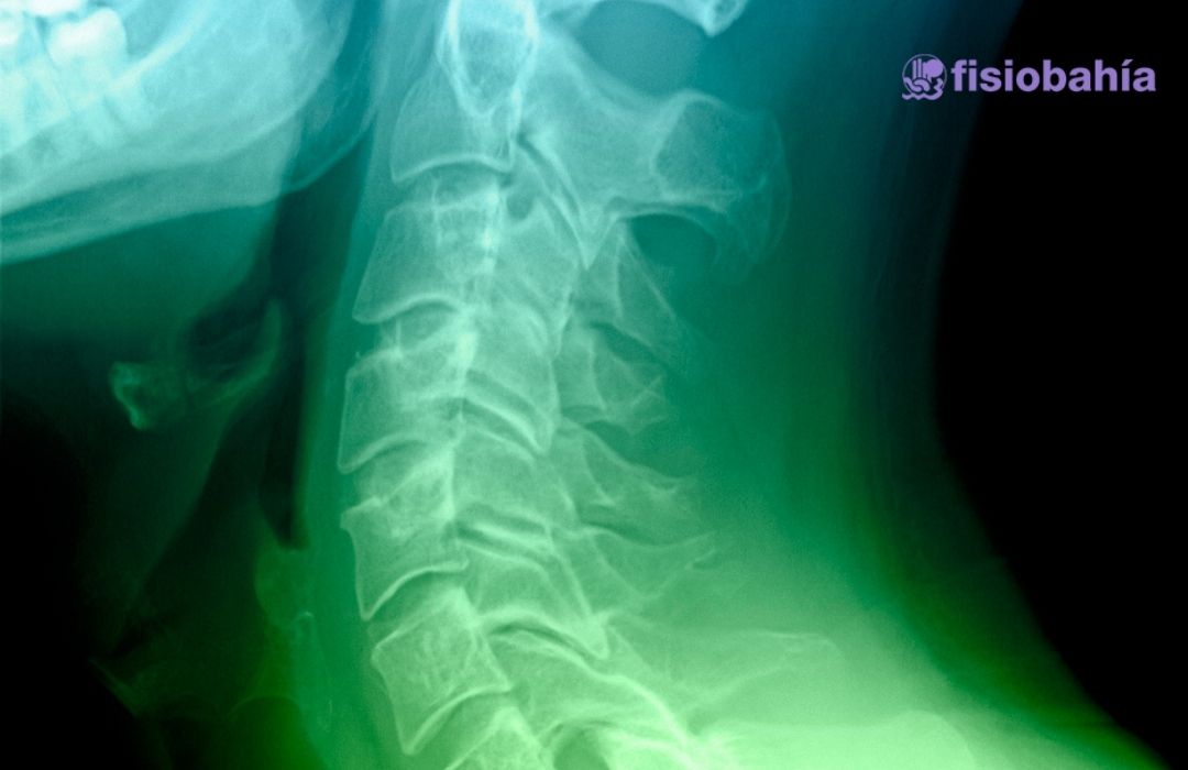 Síntomas de la rectificación de la lordosis cervical fisiológica