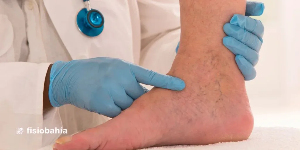 Edema como síntoma de preeclampsia
